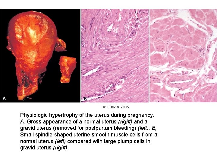 Physiologic hypertrophy of the uterus during pregnancy. A, Gross appearance of a normal uterus