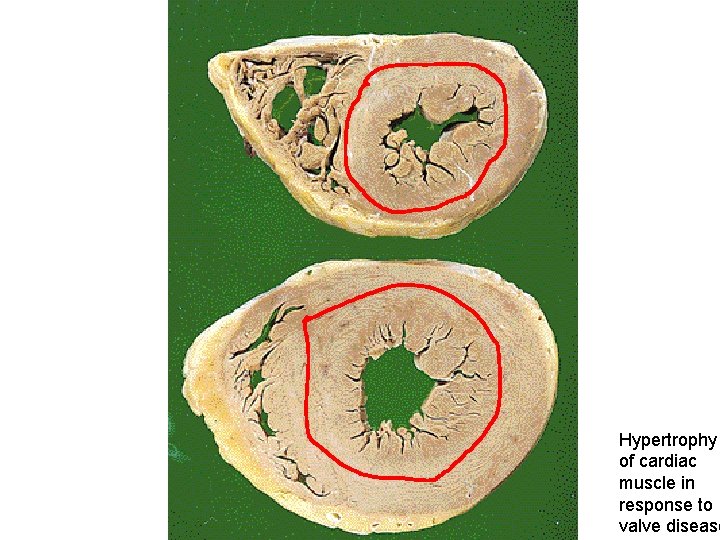 Hypertrophy of cardiac muscle in response to valve disease 