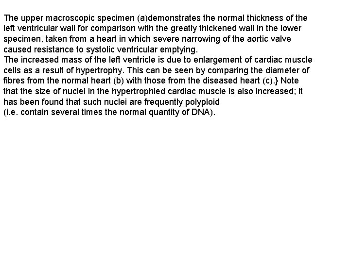 The upper macroscopic specimen (a)demonstrates the normal thickness of the left ventricular wall for