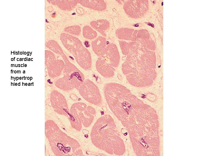 Histology of cardiac muscle from a hypertrop hied heart 