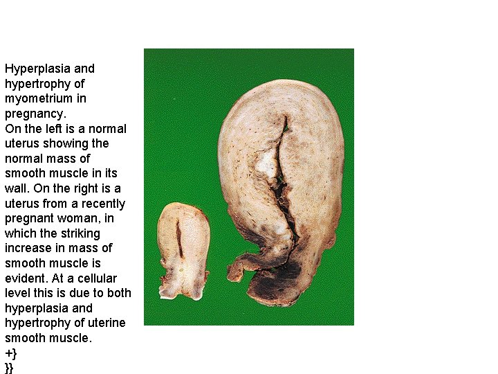 Hyperplasia and hypertrophy of myometrium in pregnancy. On the left is a normal uterus