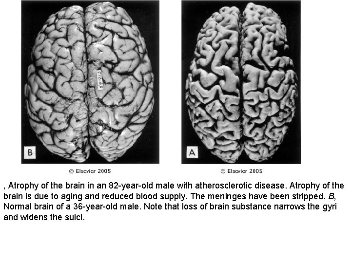 , Atrophy of the brain in an 82 -year-old male with atherosclerotic disease. Atrophy