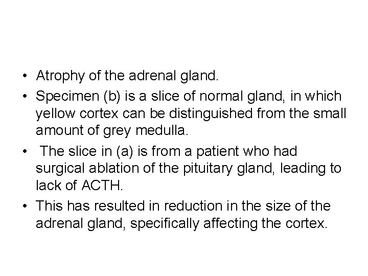  • Atrophy of the adrenal gland. • Specimen (b) is a slice of