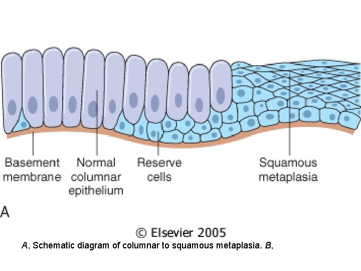 A, Schematic diagram of columnar to squamous metaplasia. B, 