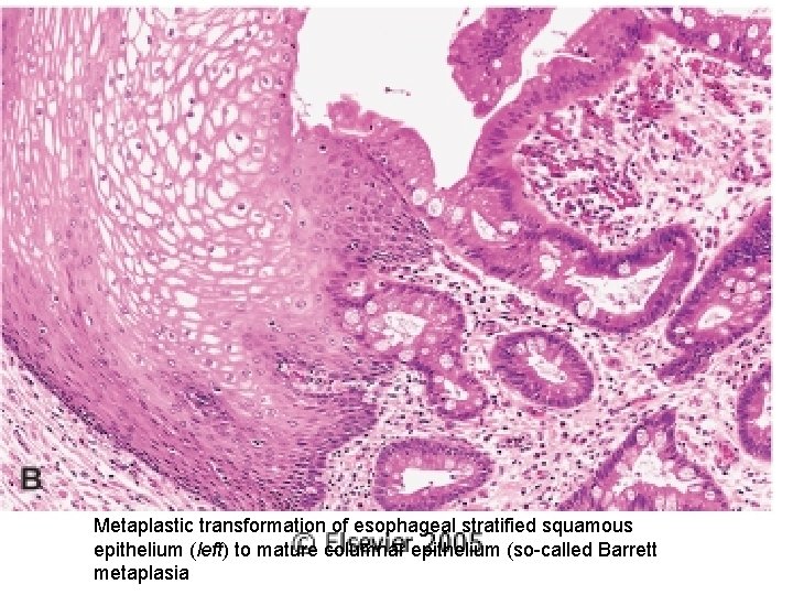 Metaplastic transformation of esophageal stratified squamous epithelium (left) to mature columnar epithelium (so-called Barrett