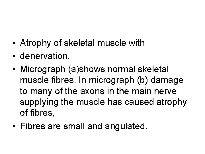  • Atrophy of skeletal muscle with • denervation. • Micrograph (a)shows normal skeletal