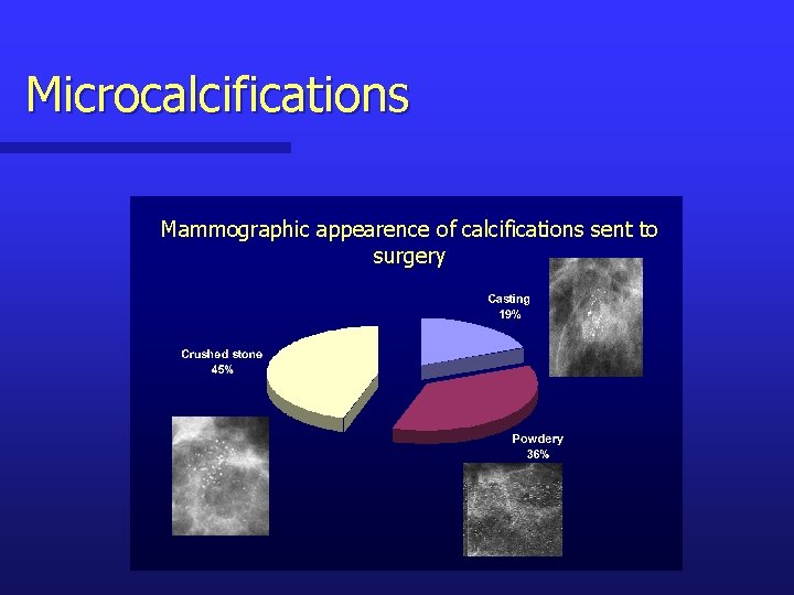 Microcalcifications Mammographic appearence of calcifications sent to surgery 