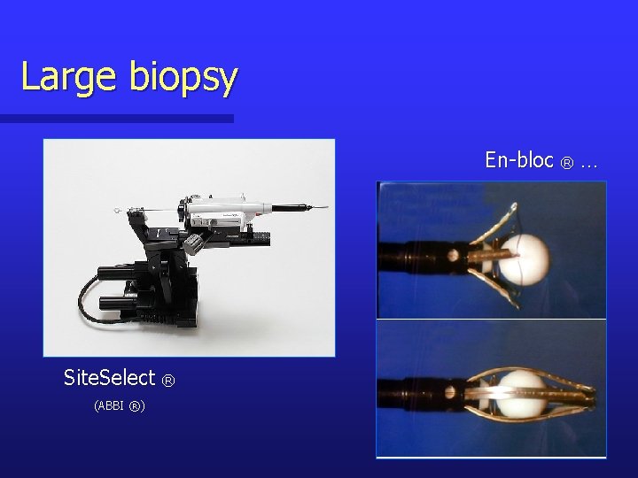 Large biopsy En-bloc ® … Site. Select ® (ABBI ®) 