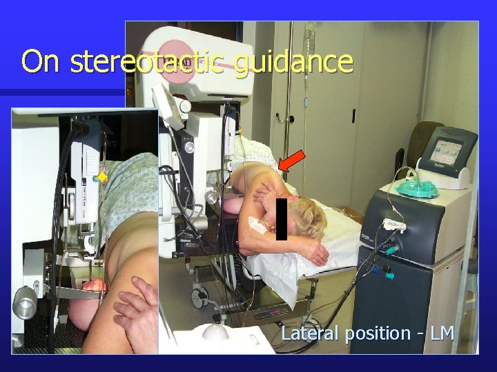 On stereotactic guidance Lateral position - LM 