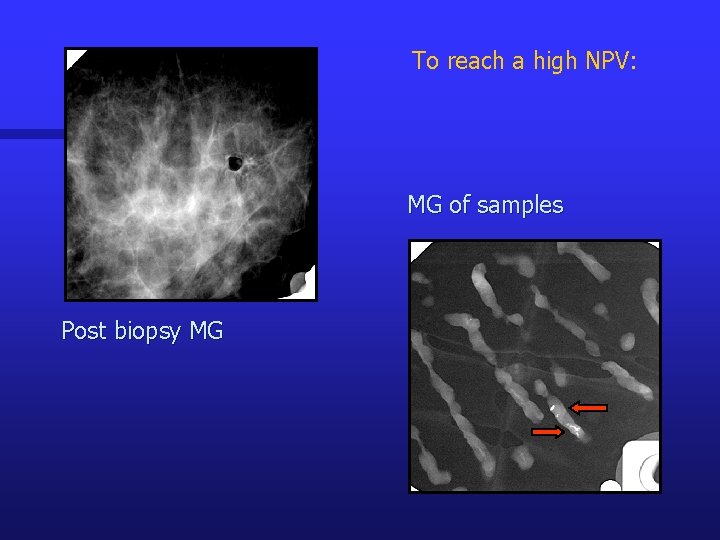 To reach a high NPV: MG of samples Post biopsy MG 