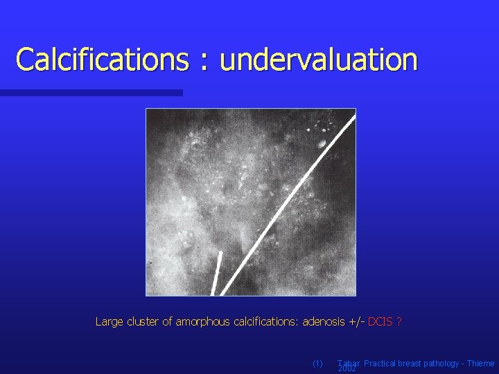 Calcifications : undervaluation Large cluster of amorphous calcifications: adenosis +/- DCIS ? (1) Tabar.