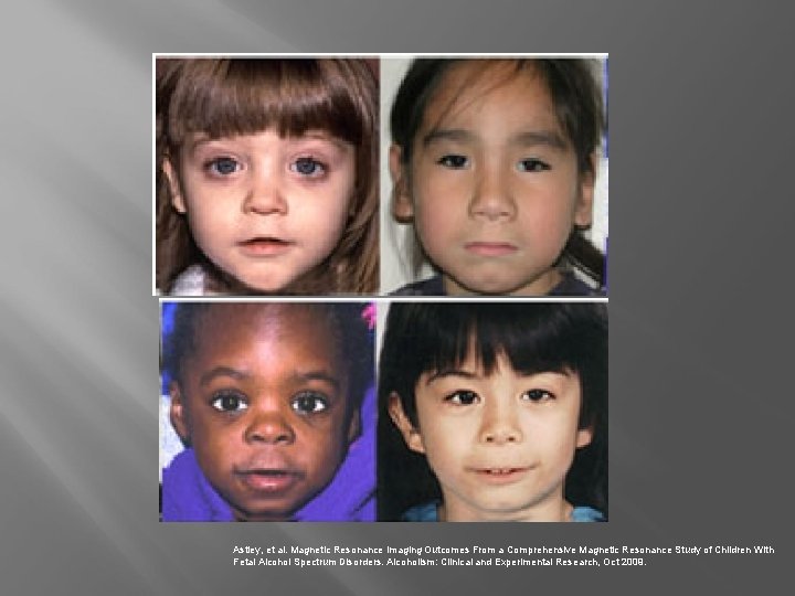 Astley, et al. Magnetic Resonance Imaging Outcomes From a Comprehensive Magnetic Resonance Study of