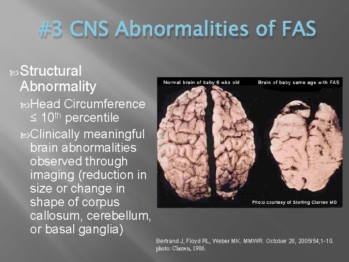 #3 CNS Abnormalities of FAS Structural Abnormality Head Circumference ≤ 10 th percentile Clinically