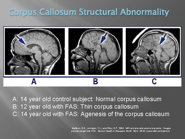 Corpus Callosum Structural Abnormality A: 14 year old control subject: Normal corpus callosum B: