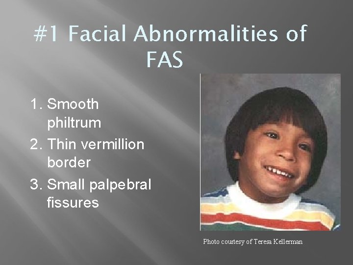 #1 Facial Abnormalities of FAS 1. Smooth philtrum 2. Thin vermillion border 3. Small