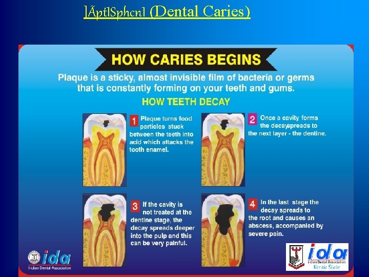 ]Ãpt. ISphcn. I (Dental Caries) 