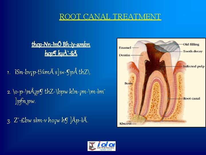 ROOT CANAL TREATMENT thcp-Nn-InÕ Bh-iy-ambn hcp¶ kµÀ`-§Ä 1. ISn bv¡p t¼mÄ s]s « ¶pÅ