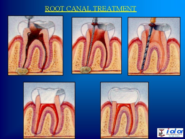 ROOT CANAL TREATMENT 