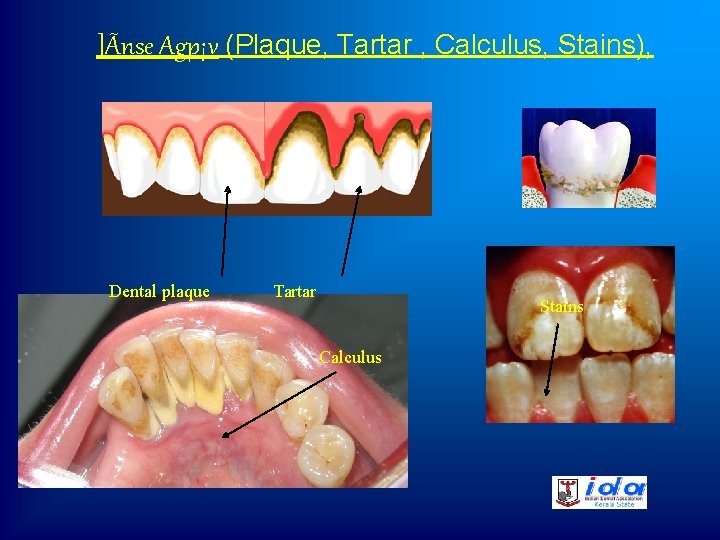 ]Ãnse Agp¡v (Plaque, Tartar , Calculus, Stains), Dental plaque Tartar Stains Calculus 