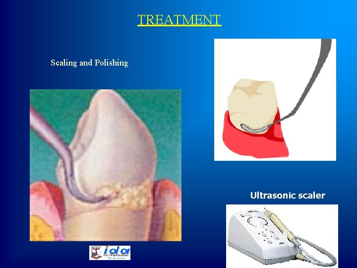 TREATMENT Scaling and Polishing Ultrasonic scaler 