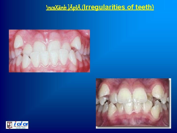 ncs. Xänb ]Ãp. IÄ (Irregularities of teeth) 