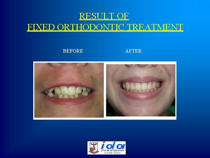 RESULT OF FIXED ORTHODONTIC TREATMENT BEFORE AFTER 