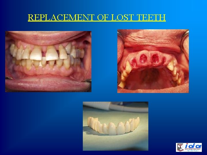 REPLACEMENT OF LOST TEETH 