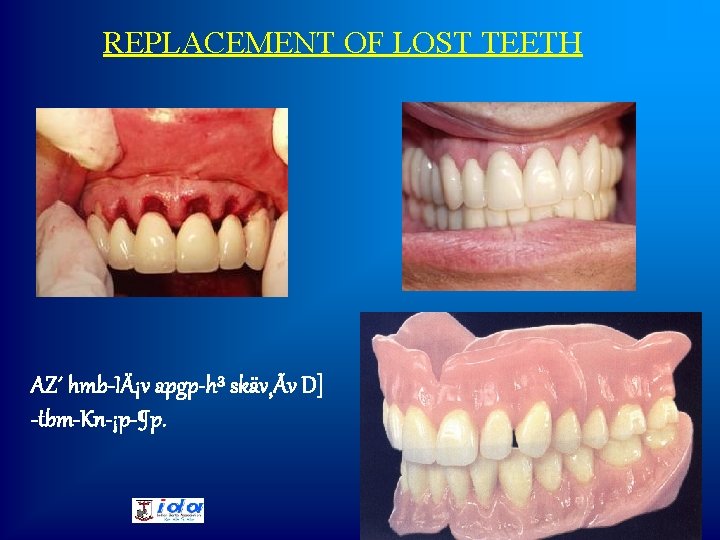 REPLACEMENT OF LOST TEETH AZ´ hmb-IÄ¡v apgp-h³ skäv¸Ãv D] -tbm-Kn-¡p-¶p. 