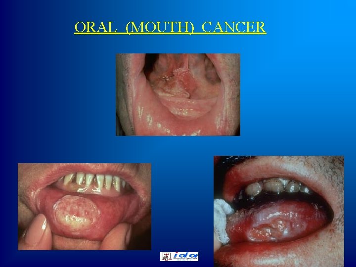 ORAL (MOUTH) CANCER 