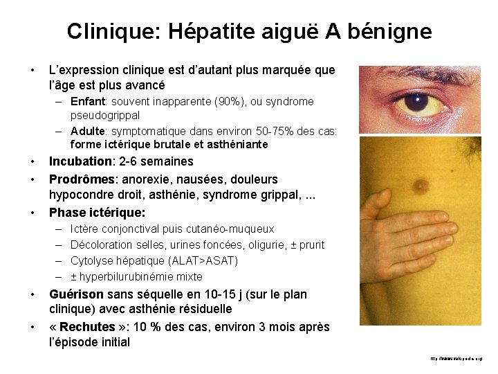 Clinique: Hépatite aiguë A bénigne • L’expression clinique est d’autant plus marquée que l’âge