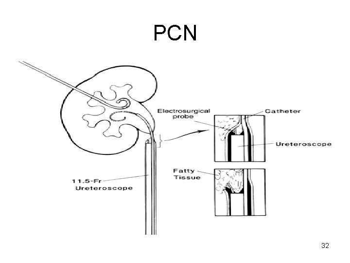 PCN 32 