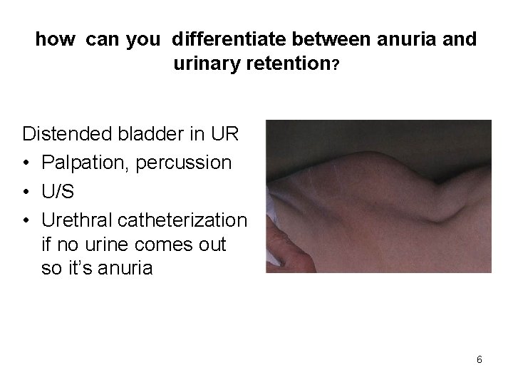 how can you differentiate between anuria and urinary retention? Distended bladder in UR •