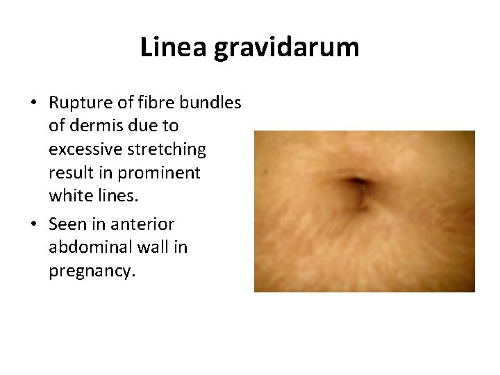 Linea gravidarum • Rupture of fibre bundles of dermis due to excessive stretching result