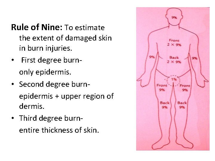 Rule of Nine: To estimate the extent of damaged skin in burn injuries. •