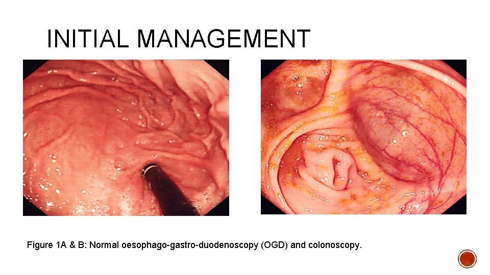INITIAL MANAGEMENT Figure 1 A & B: Normal oesophago-gastro-duodenoscopy (OGD) and colonoscopy. 