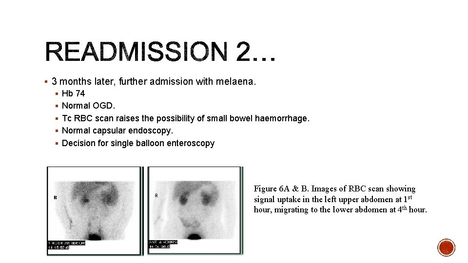 § 3 months later, further admission with melaena. § Hb 74 § Normal OGD.