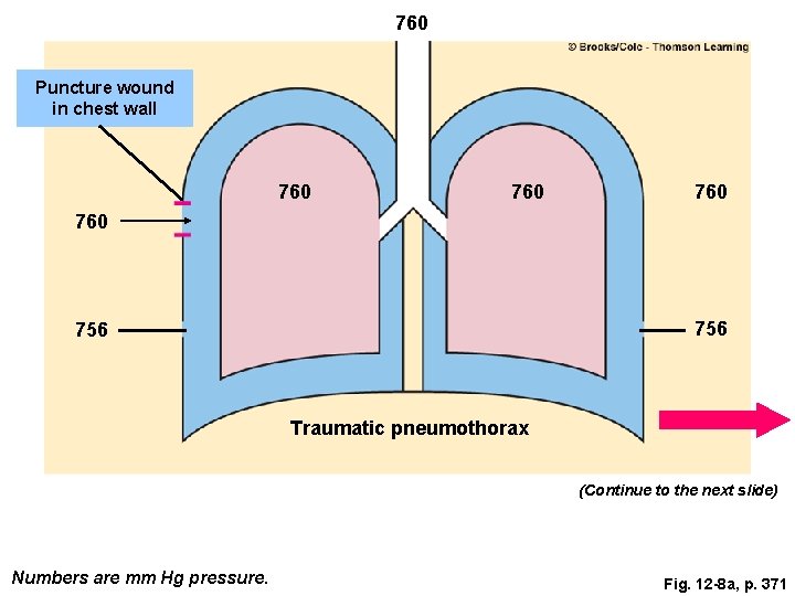 760 Puncture wound in chest wall 760 760 756 Traumatic pneumothorax (Continue to the 760 Puncture wound in chest wall 760 760 756 Traumatic pneumothorax (Continue to the