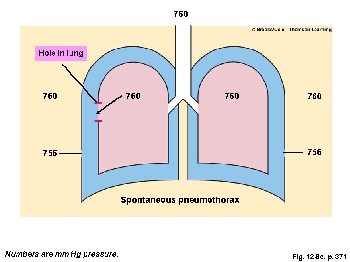 760 Hole in lung 760 760 756 Spontaneous pneumothorax Numbers are mm Hg pressure. 760 Hole in lung 760 760 756 Spontaneous pneumothorax Numbers are mm Hg pressure.