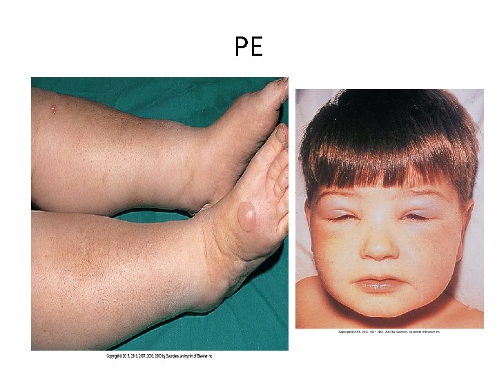PE 