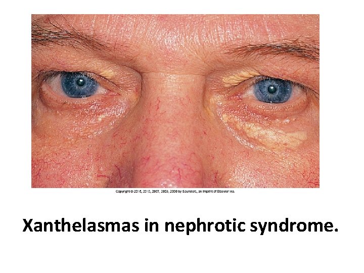 Xanthelasmas in nephrotic syndrome. 