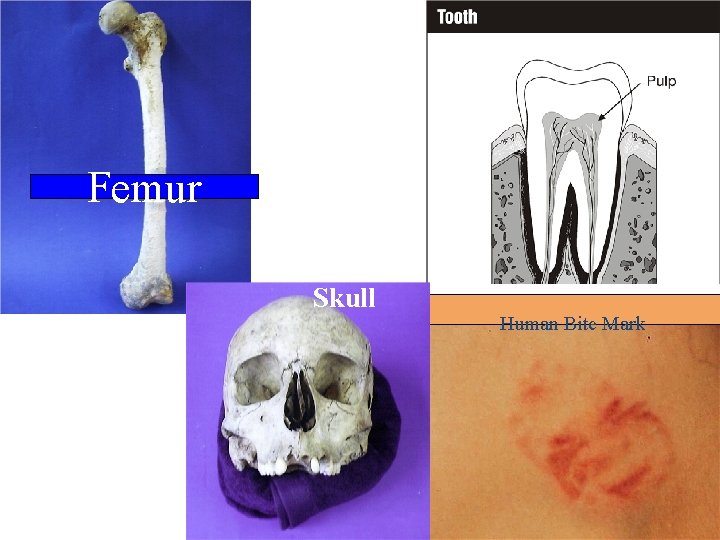 Femur Skull Human Bite Mark 