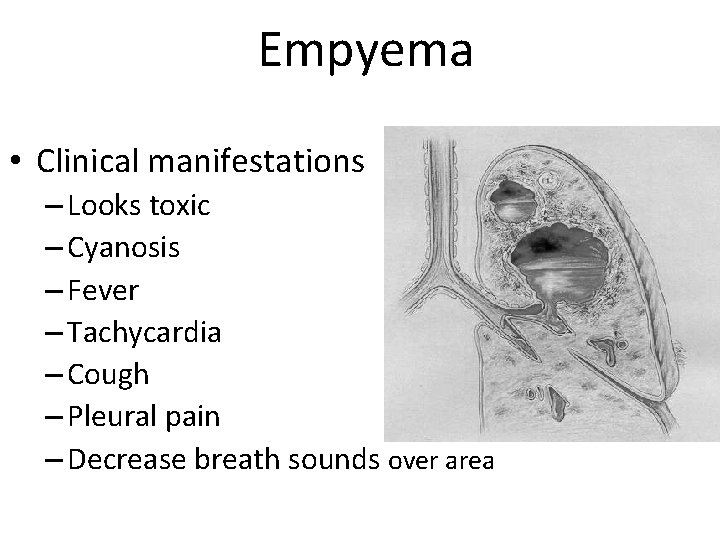 Empyema • Clinical manifestations – Looks toxic – Cyanosis – Fever – Tachycardia –