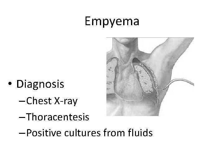 Empyema • Diagnosis – Chest X-ray – Thoracentesis – Positive cultures from fluids 