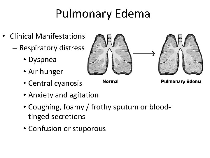 Pulmonary Edema • Clinical Manifestations – Respiratory distress • Dyspnea • Air hunger •