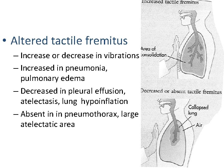  • Altered tactile fremitus – Increase or decrease in vibrations – Increased in