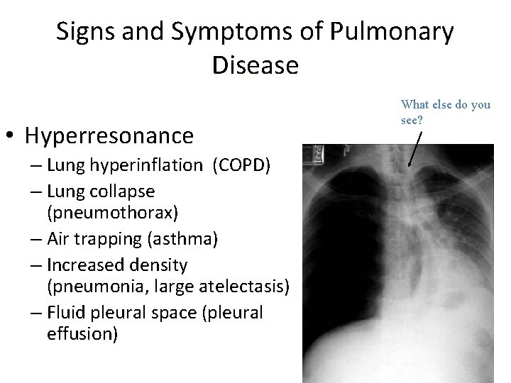 Signs and Symptoms of Pulmonary Disease • Hyperresonance – Lung hyperinflation (COPD) – Lung