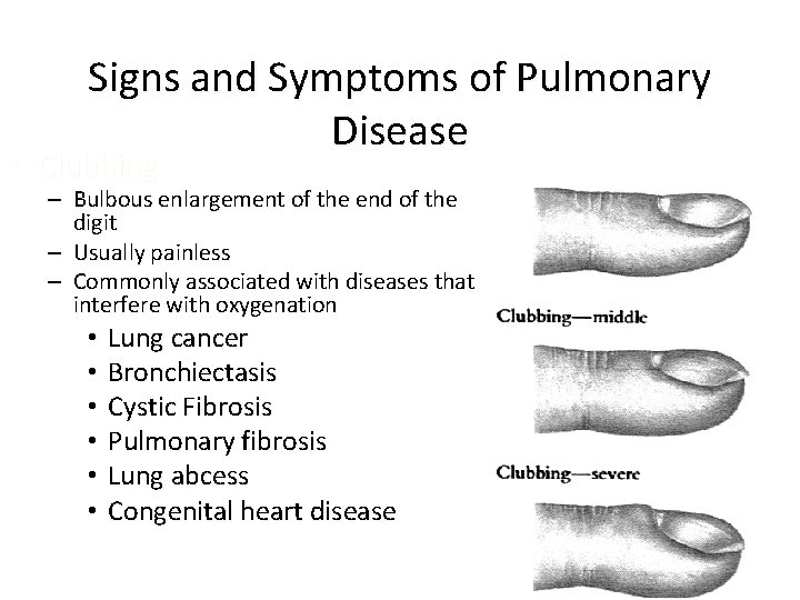 Signs and Symptoms of Pulmonary Disease • Clubbing – Bulbous enlargement of the end