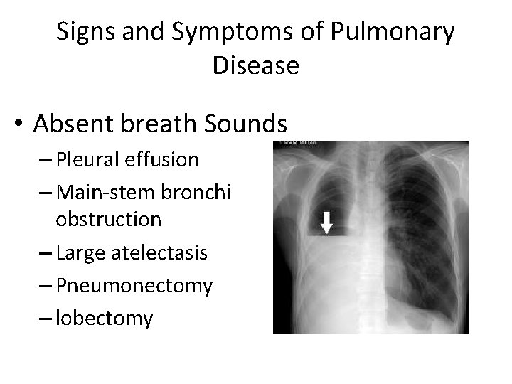 Signs and Symptoms of Pulmonary Disease • Absent breath Sounds – Pleural effusion –