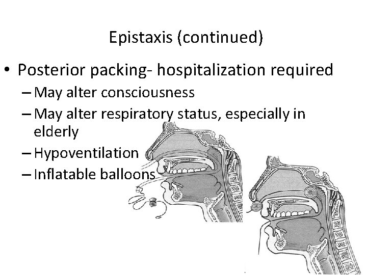 Epistaxis (continued) • Posterior packing- hospitalization required – May alter consciousness – May alter