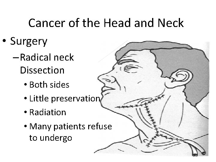 Cancer of the Head and Neck • Surgery – Radical neck Dissection • Both